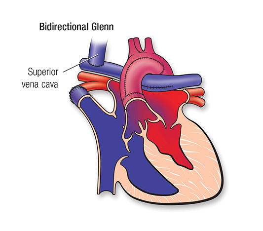 50-1683-62a HLHS Repair Bidirectional Glenn illustration